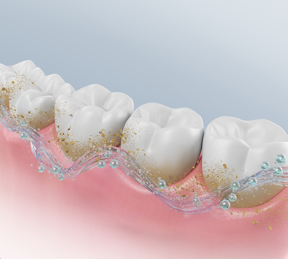 Tooth,Whitening,,Tooth,Cleaning,,Healthy,Gums,And,Teeth,With,Fluoride